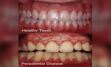 Gum Disease: Causes, Symptoms, and Risk Factors