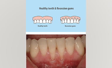 Gum Recession: Causes, Symptoms, Prevention, and Treatment Options